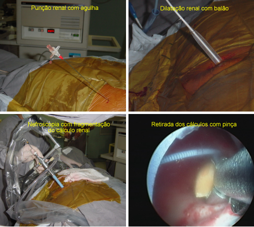 Tratamento para Cálculo Renal